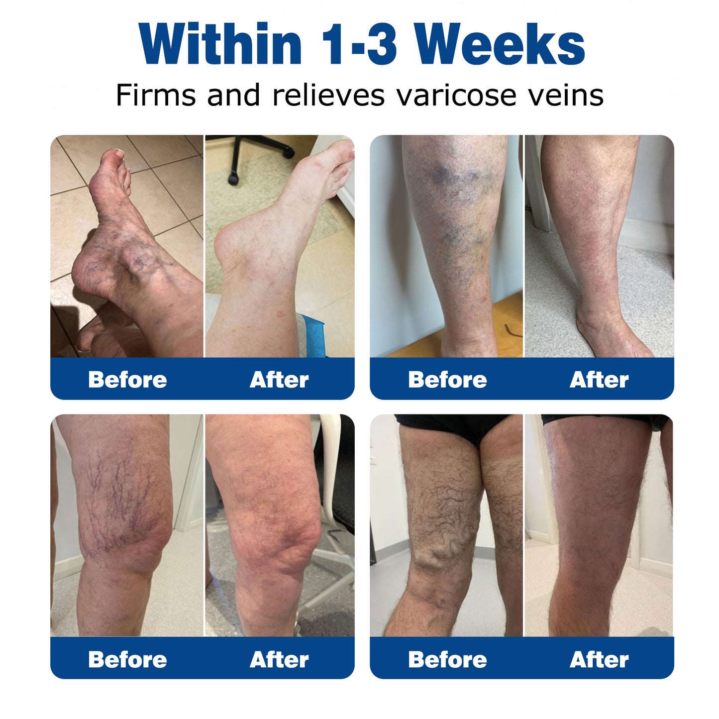 🇬🇧🌿GFOUК® VeinEase Microneedle Care Patch⚡Instant Relief, Long-Term Results