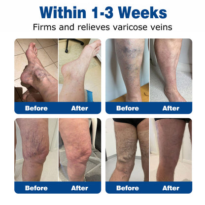 🇬🇧🌿GFOUК® VeinEase Microneedle Care Patch⚡Instant Relief, Long-Term Results